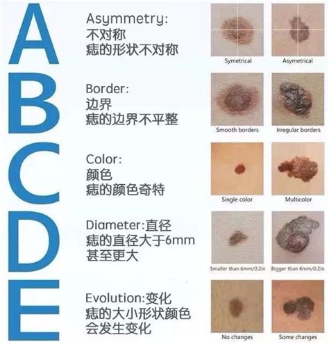 痣 顏色|是痣還是癌？醫師以ABCDE原則教你辨識